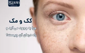 کک و مک صورت چیست و چطور درمان می شود؟ - کیاوین