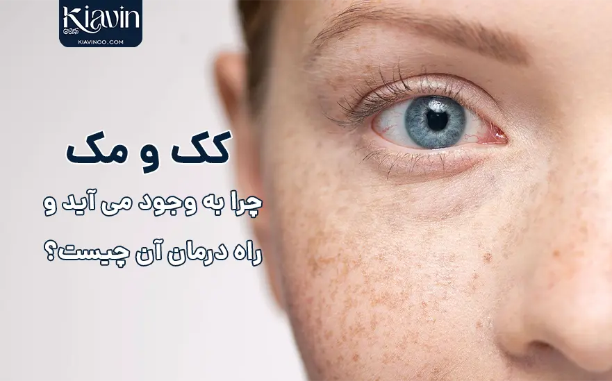 کک و مک صورت چیست و چطور درمان می شود؟ - کیاوین